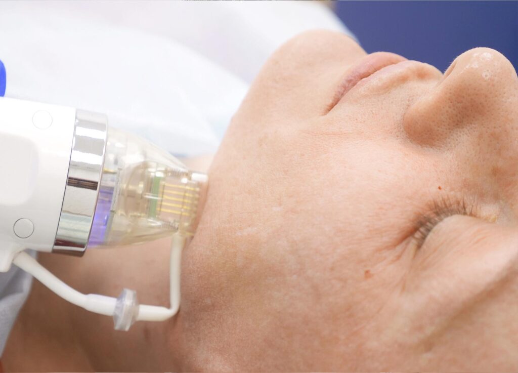 RF Microneedling Georgetown, TX